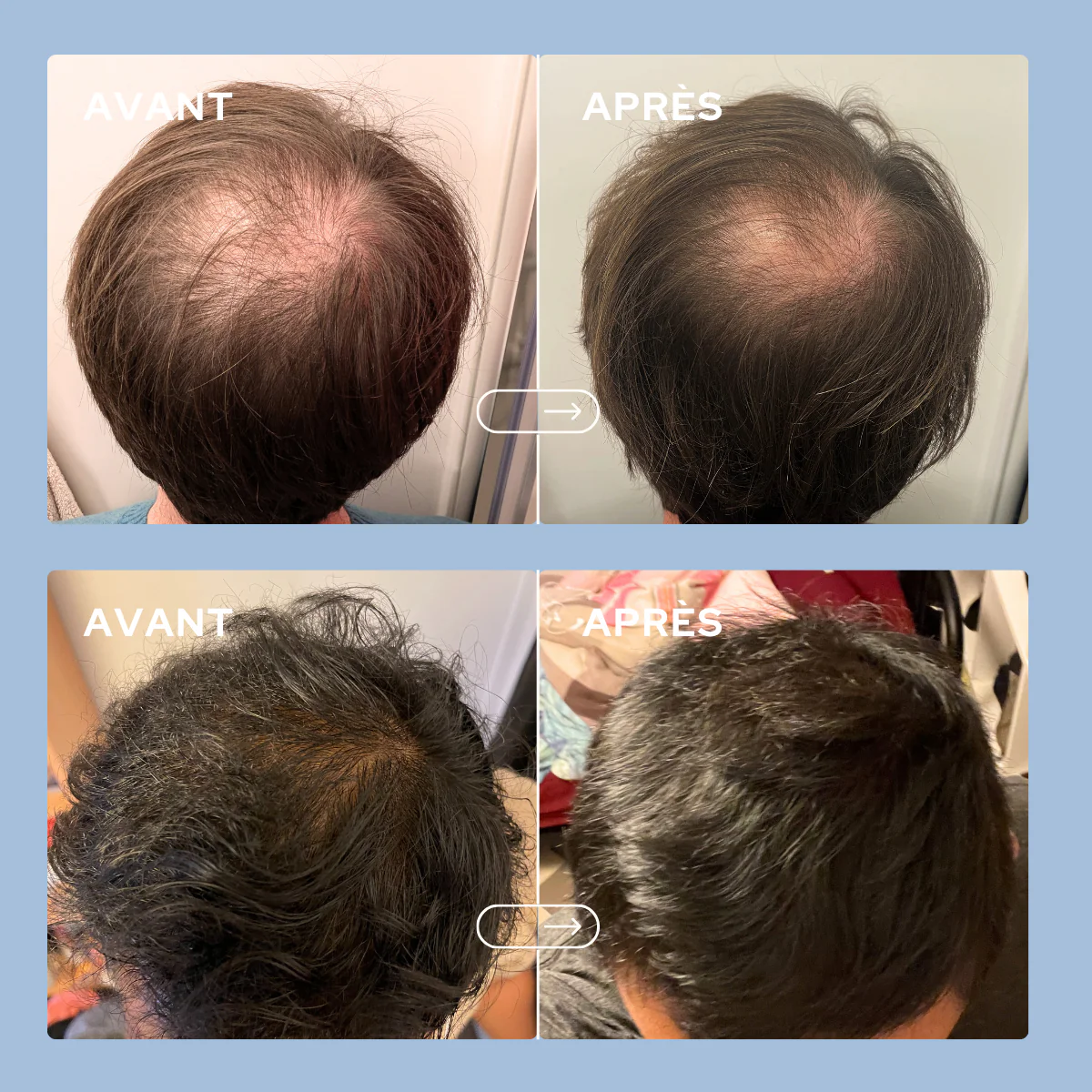 Cure anti-chute de cheveux hommes - Image 5